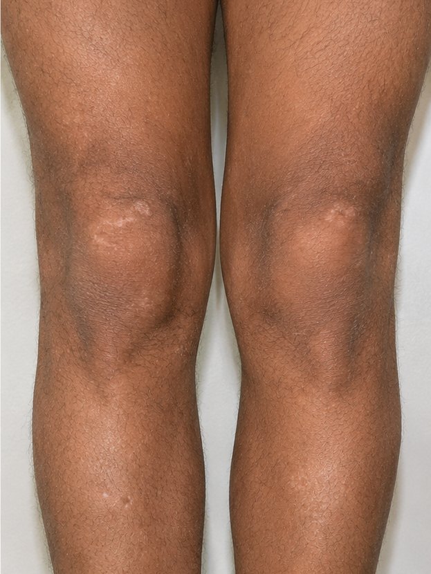 Knees & shins — After