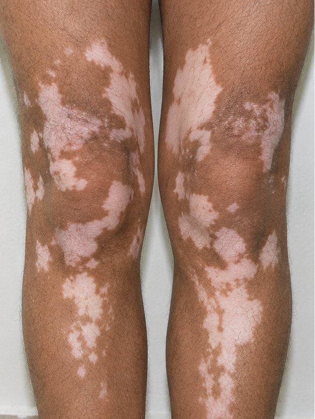 Knees & shins — Before