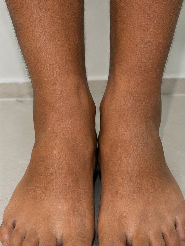 Feet & toes — After