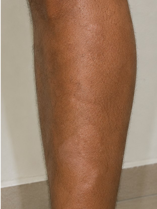 Shin & calf — After