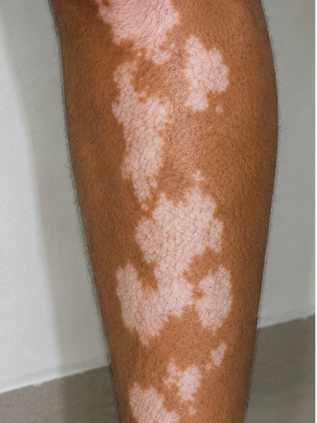 Shin & calf — Before